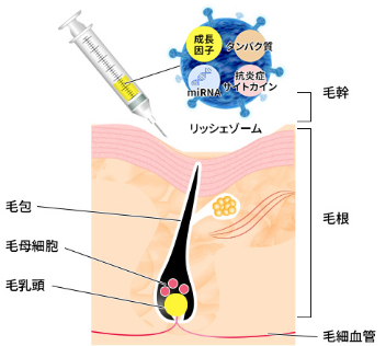 RichExosome(リッシェゾーム)を注入