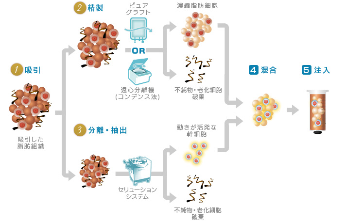 セリューション豊胸術（脂肪幹細胞豊胸術）とは