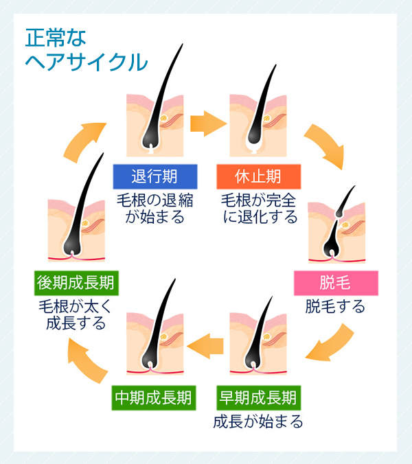 幹細胞を注入し、毛包を活発化