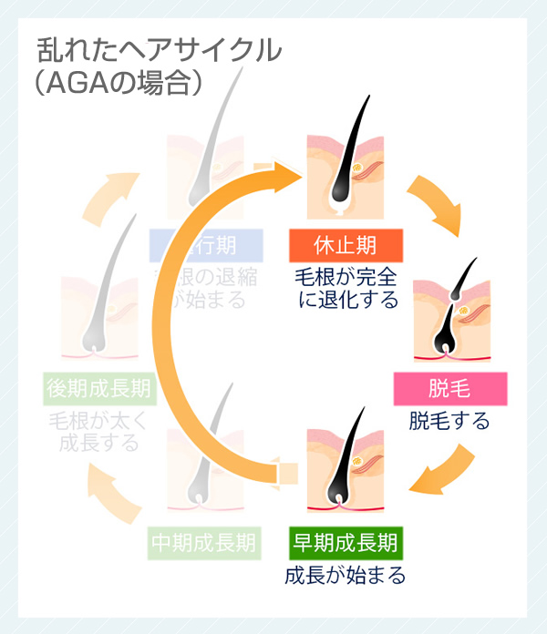 乱れたヘアサイクル(AGAの場合)